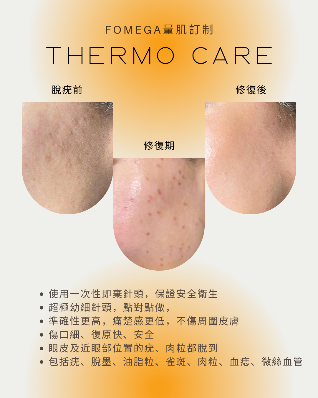 THERMO CARE 熱能氣化療程!脫疣專家!