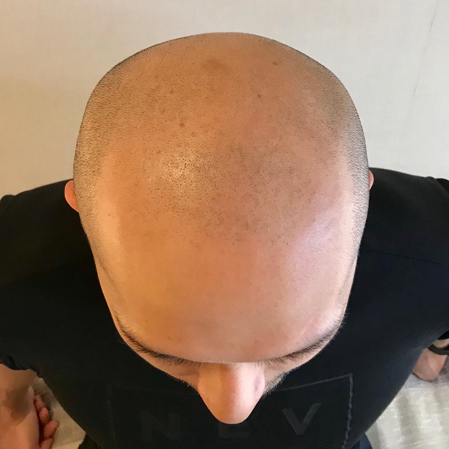 SMP輕霧感頭皮著色療程