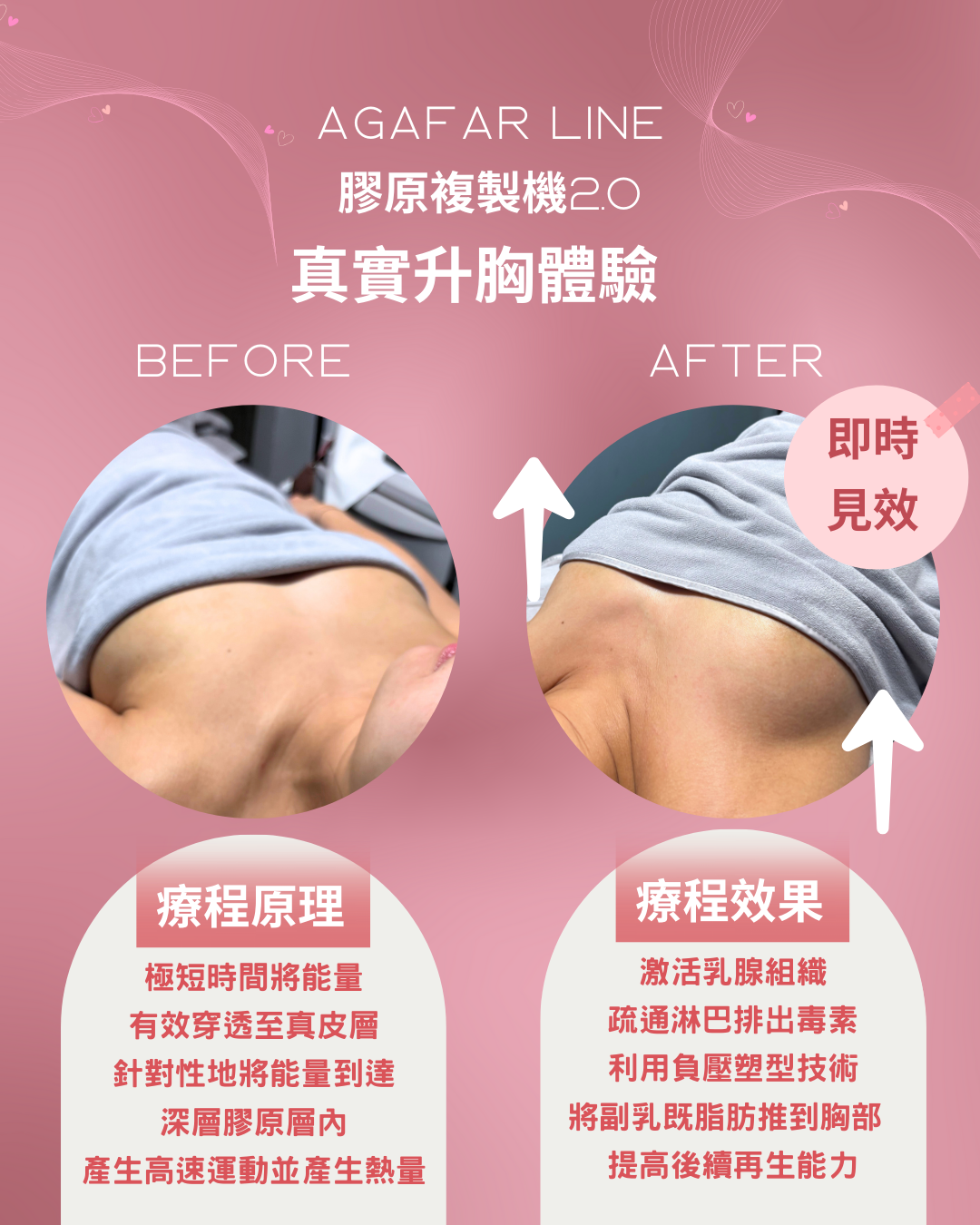 纖索爆脂膠原自生療程AGAFAR LINE 訂金