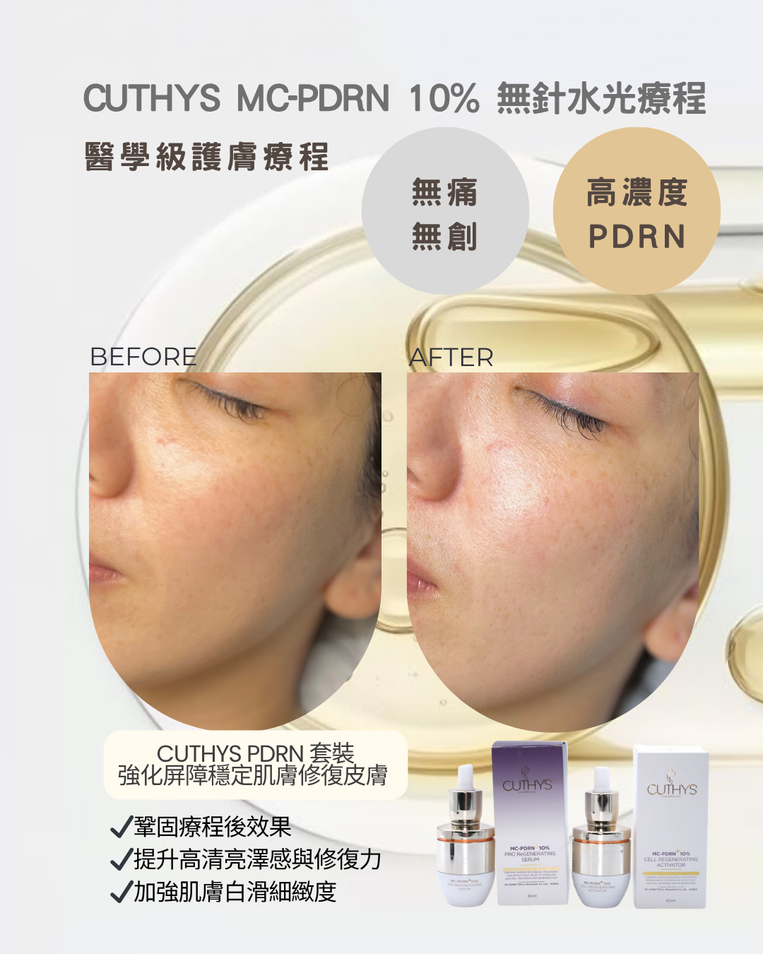 CUTHYS MC-PDRN  10% 無針水光療程