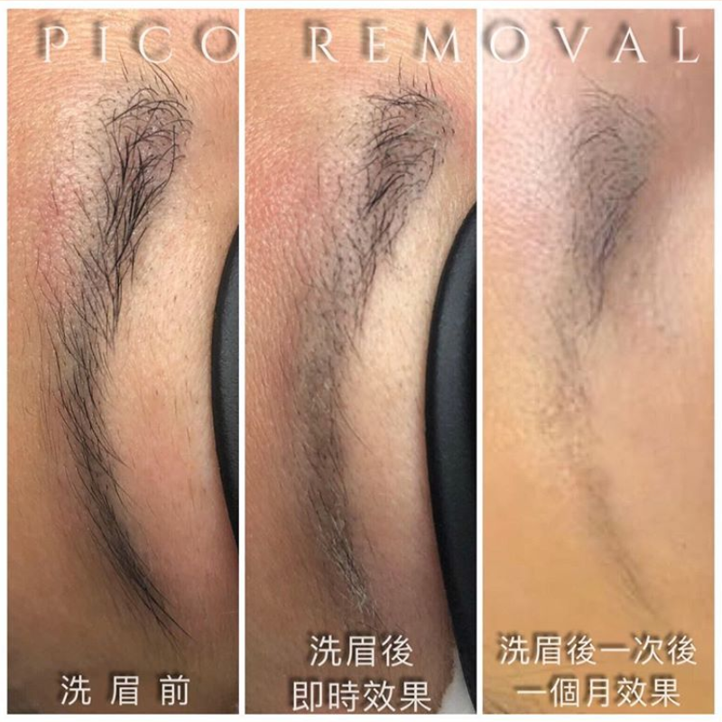 皮秒激光洗眉