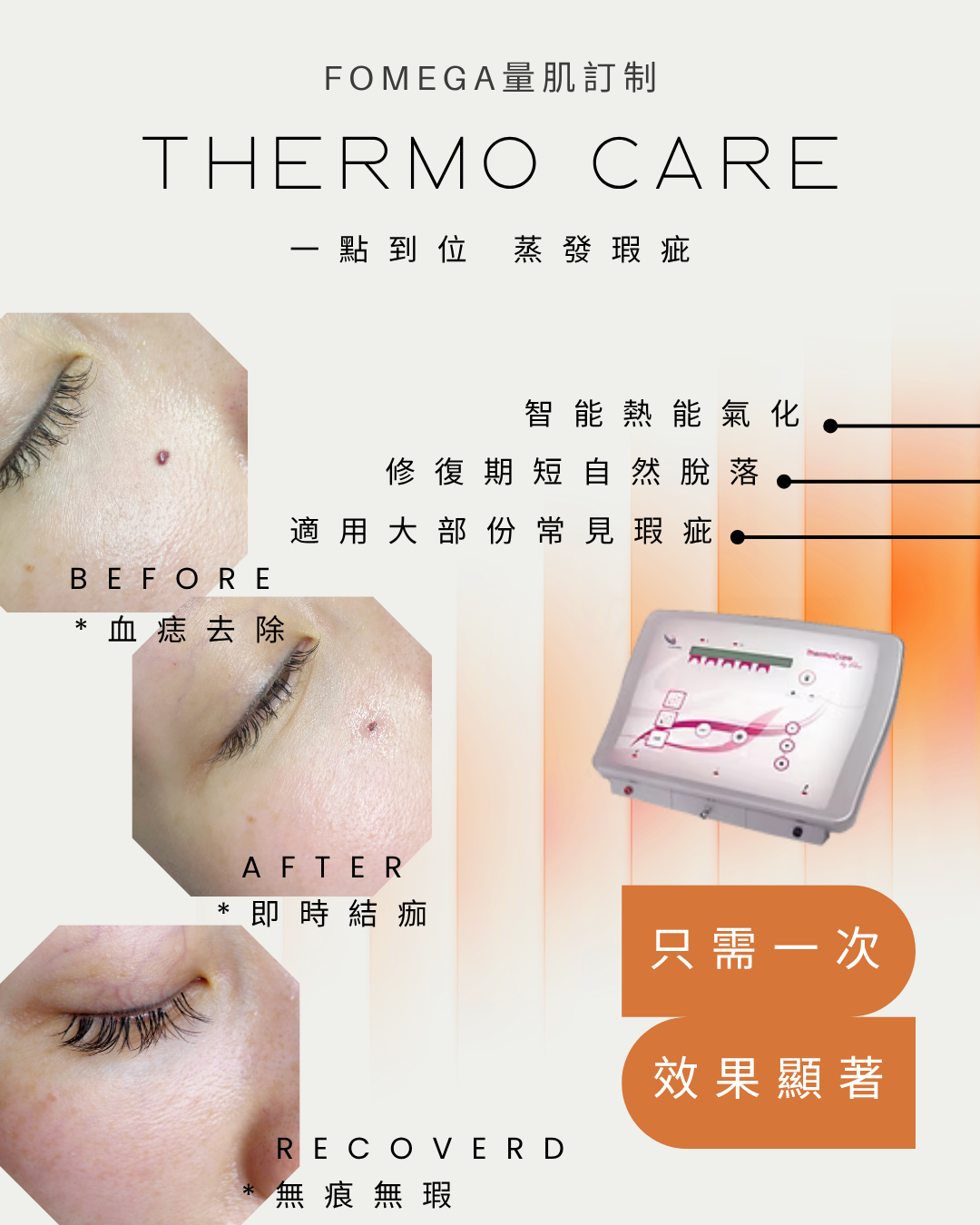 THERMO CARE 熱能氣化療程！脫疣專家！