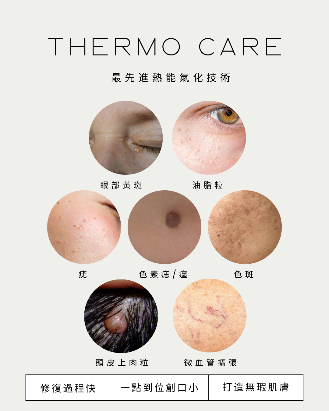 THERMO CARE 熱能氣化療程！脫疣專家！