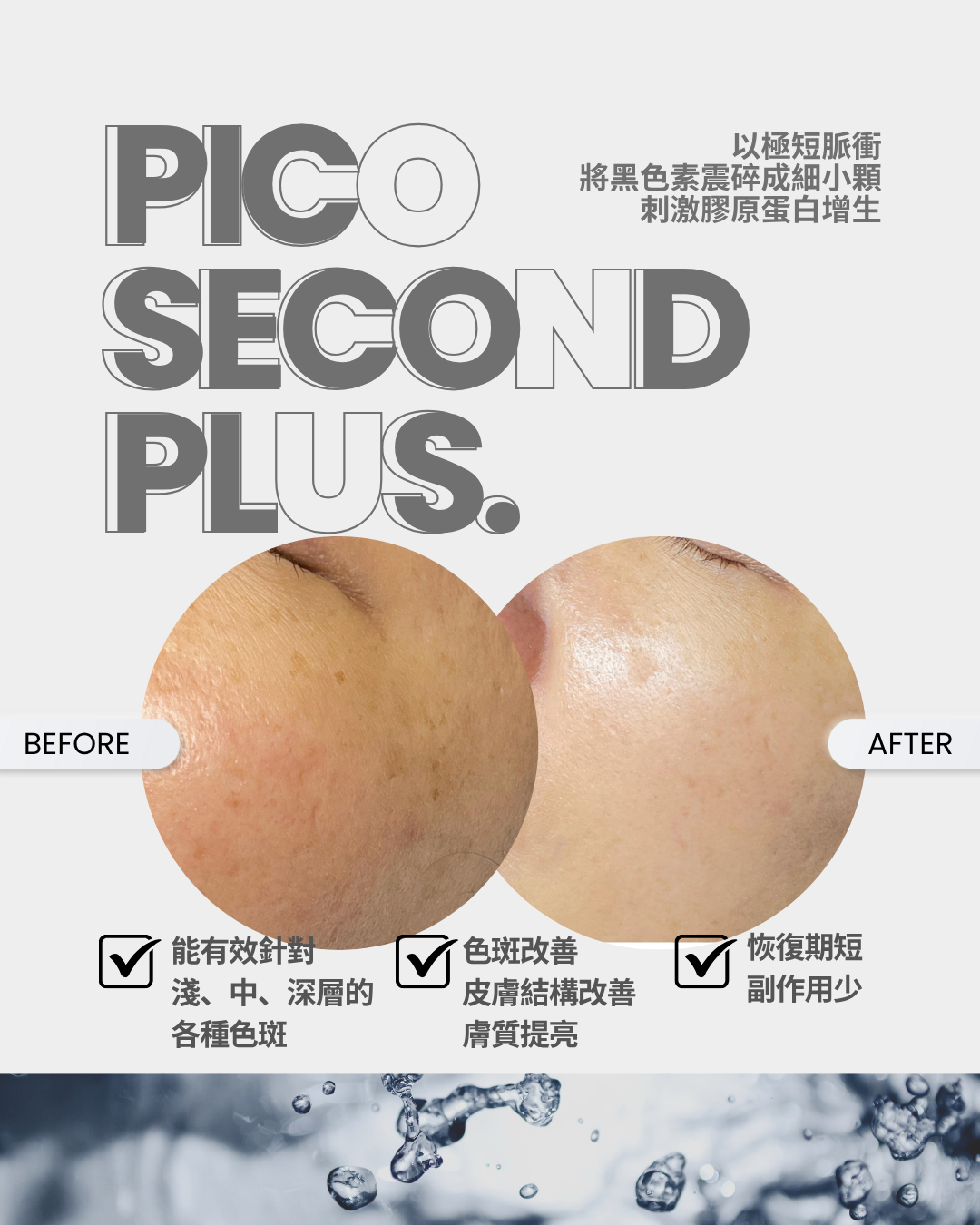 升級版sMTS  無針幹細胞嬰兒針