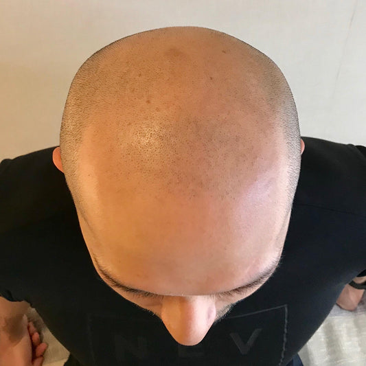 SMP輕霧感頭皮著色療程